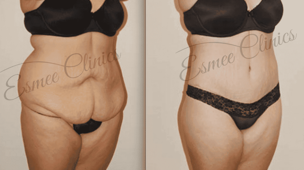 Before and After img